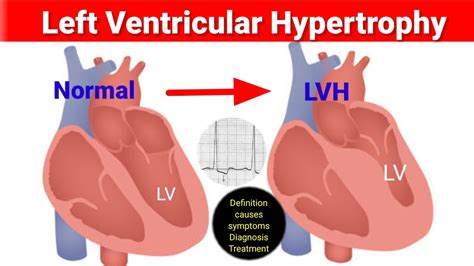 can stress cause left ventricular hypertrophy.